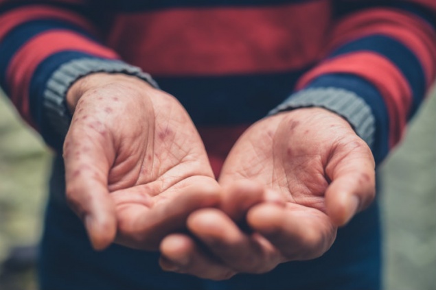 Осторожно, корь: что это за болезнь и почему она так опасна