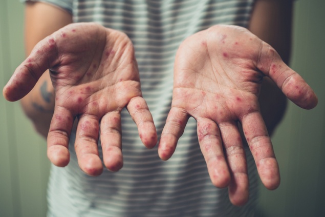 Корь: зачем делать прививку и какие сдавать анализы