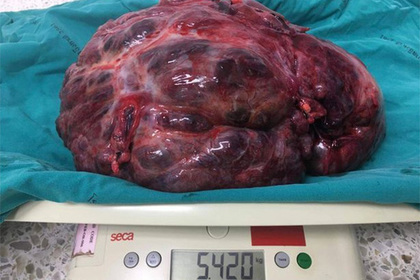 Мужчина пожаловался на боль в животе и перенес удаление огромной опухоли