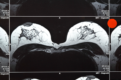 Нарощенные волосы спасли женщину от рака груди третьей стадии