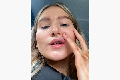 Студентка решила увеличить губы и едва их не потеряла