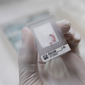 У жителей стали чаще выявлять опухоли: на первом месте рак легких