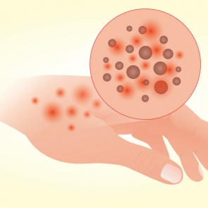 Атопический дерматит: симптомы и лечение