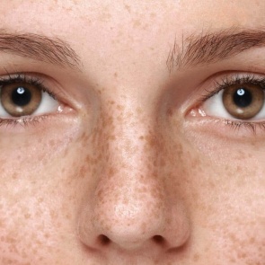 ПИГМЕНТНЫЕ ПЯТНА НА ТЕЛЕ И ЛИЦЕ: ПОЧЕМУ ПОЯВЛЯЮТСЯ, И КАК ОТ НИХ ИЗБАВИТЬСЯ