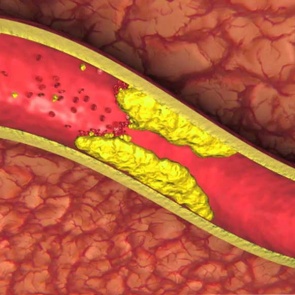 НАРОДНЫЕ СРЕДСТВА ЛЕЧЕНИЯ ДЛЯ СОСУДОВ ГОЛОВНОГО МОЗГА