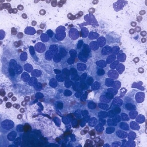 Ученые успешно протестировали новую терапию для лечения рака поджелудочной железы