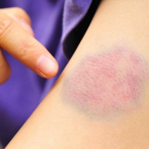 Синяки: о чем говорит «темная метка»?