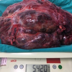 Мужчина пожаловался на боль в животе и перенес удаление огромной опухоли