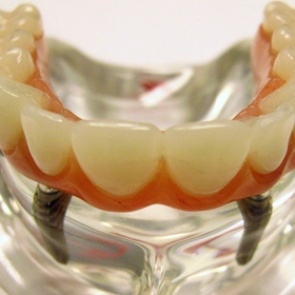 Зубные имплантаты признали опасными