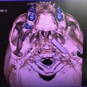 Врачи достали из головы маленькой жительницы Кемерово часть кисти для рисования. Она была там полгода