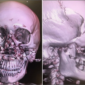 Хирурги БСМП по крупицам собрали раздробленное при аварии лицо девушки