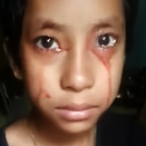 Восьмилетняя девочка начала потеть и плакать кровью