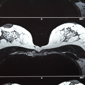 Нарощенные волосы спасли женщину от рака груди третьей стадии